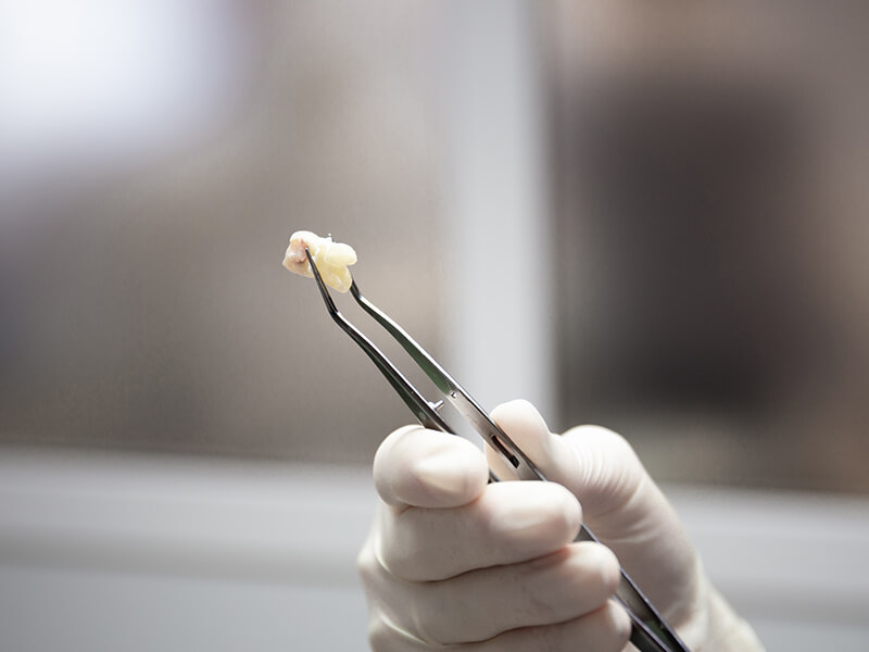 extração de dentes do siso