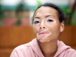 mulher com vitiligo